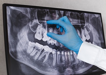 Dental team member using digital impression scanner on patient