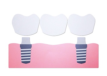 example of implant dental bridge in South Windsor