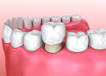 dental crown being placed over a tooth 