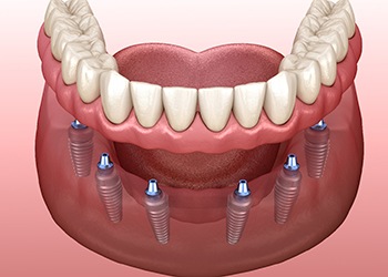 implant dentures representing cost of dentures in South Windsor