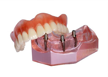 Model of implant denture