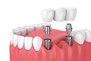 dental bridge supported by two dental implants