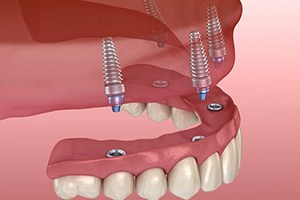 implant denture on the upper arch