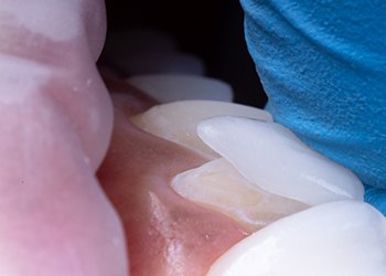 A veneer being placed onto a tooth