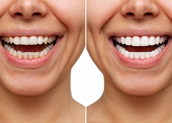 Up close before and after images of person with veneers