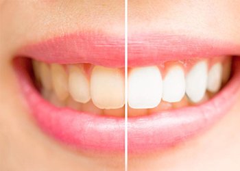 Teeth whitening before and after