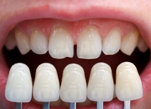 A set of veneers compared to imperfect teeth.