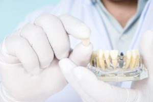 dentist showing model of implants