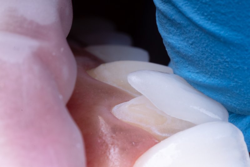 a dentist placing veneers onto a patient’s smile