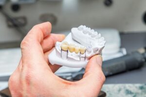 Hand holding model with a dental bridge